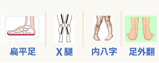 矫正内八字最快的要领 怎样矫正内八字