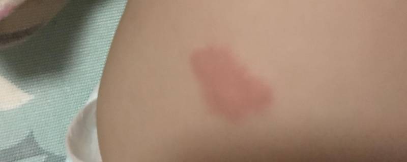 胎记的源由