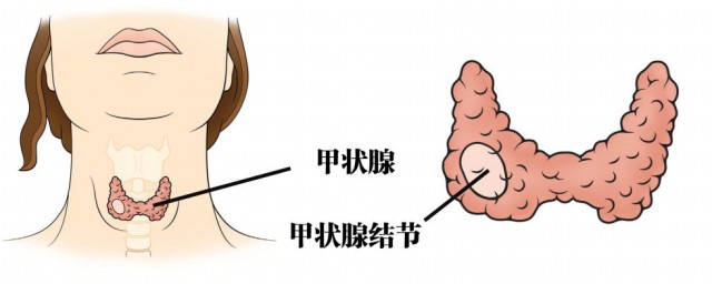 甲状腺不能吃 甲状腺不能吃什么