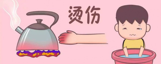 手被烫伤了怎么办 手被烫伤了如何解决
