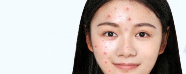 去除粉刺的护理方式 去除粉刺怎么护理