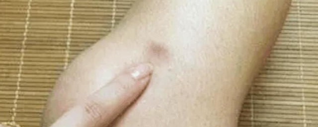 腿上莫名有淤青真是被鬼掐的吗 腿上莫名有淤青是不是被鬼掐的