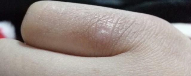 冻疮怎么治 冻疮如何治