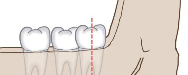 智齿为什么会疼 智齿会疼的原因