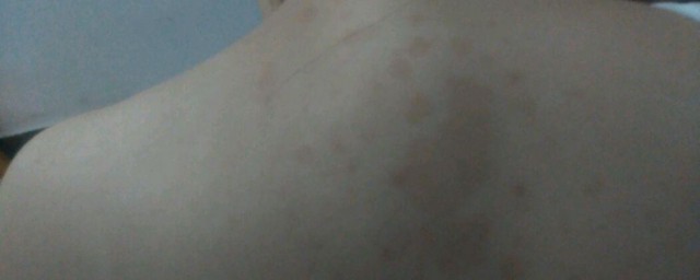 汗斑的鉴别方法 汗斑的鉴别和治疗方法