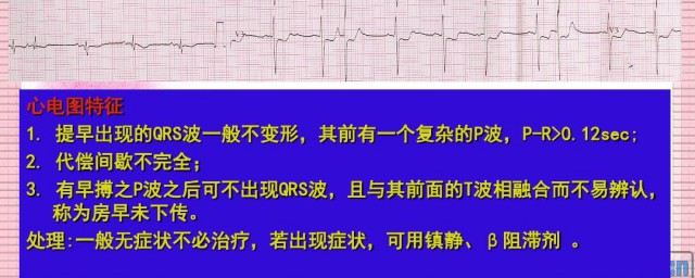 心电图ecg是什么意思 心电图ecg是何意