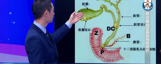 胆总管扩张是什么意思 胆总管扩张的意思是