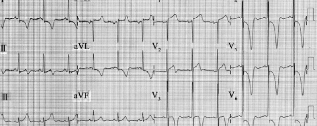 心电图st-t改变是什么意思出现 心电图st-t改变有哪些含义