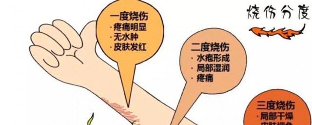 烧伤如何处理好的快 烧伤怎么处理