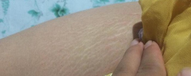 怎么去除妊娠纹 去除妊娠纹的方法