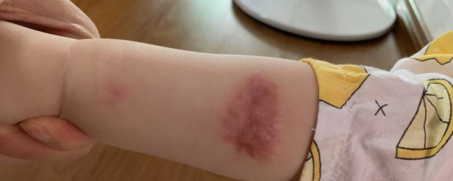烫伤疤痕如何消除 如何消除烫伤疤痕