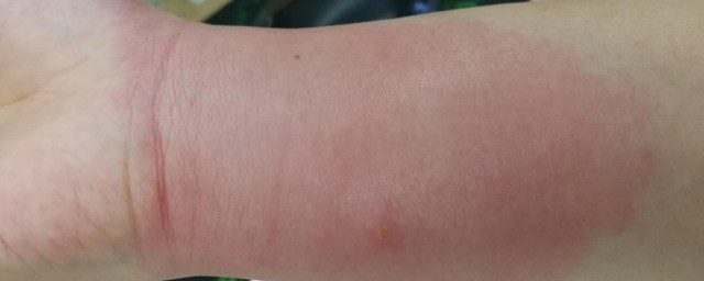 红火蚁咬了红肿痒怎样办 红火蚁咬了红肿痒解决办法