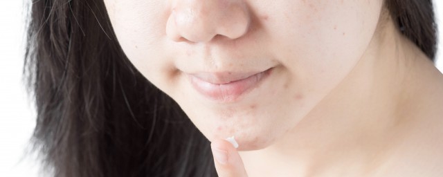 脸上痘痘出血了能敷面膜吗 脸上长痘痘是什么原因