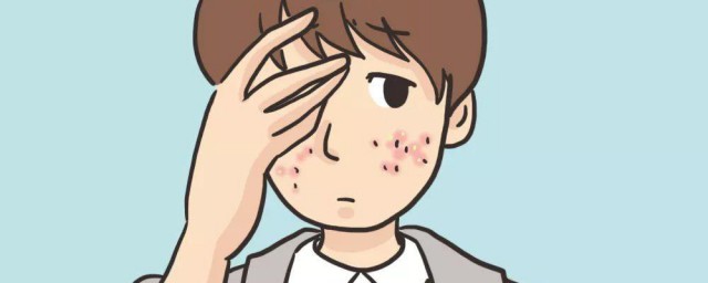 怎样做不容易起痘痘 不容易起痘痘技巧