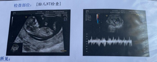 产检nt是检查什么 nt检查介绍