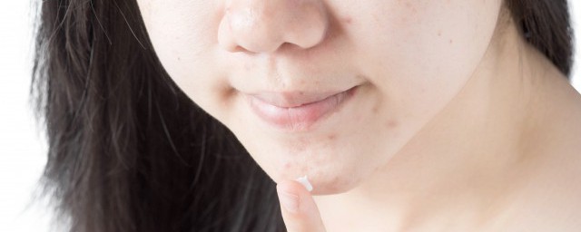 女生祛痘的最快技巧 女生祛痘的最快最简单的技巧