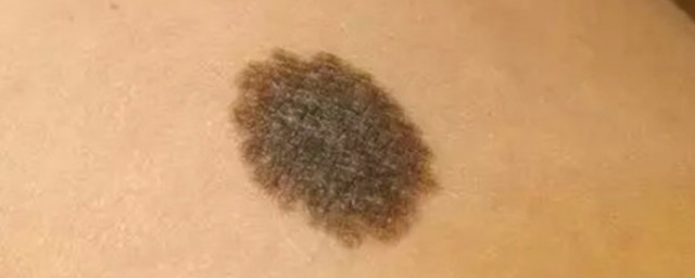 什么是朱砂痣 朱砂痣简单简介