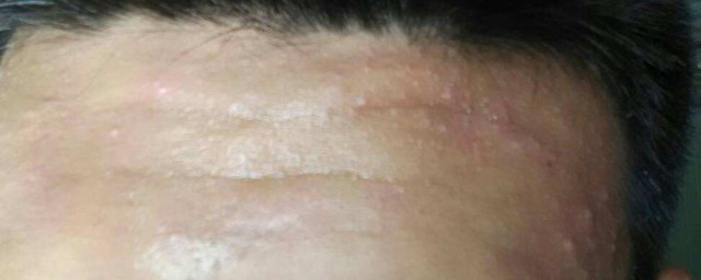 头上起痘痘是怎样回事 头皮上长痘痘原因是什么