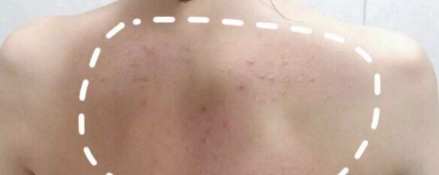 背部长痘痘是什么原因 背部长痘痘是什么导致的