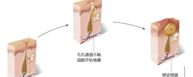 毛孔堵塞长痘如何办 毛孔堵塞长痘解决方法
