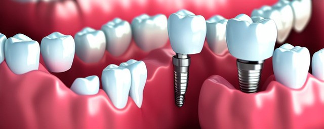 种植牙是什么意思